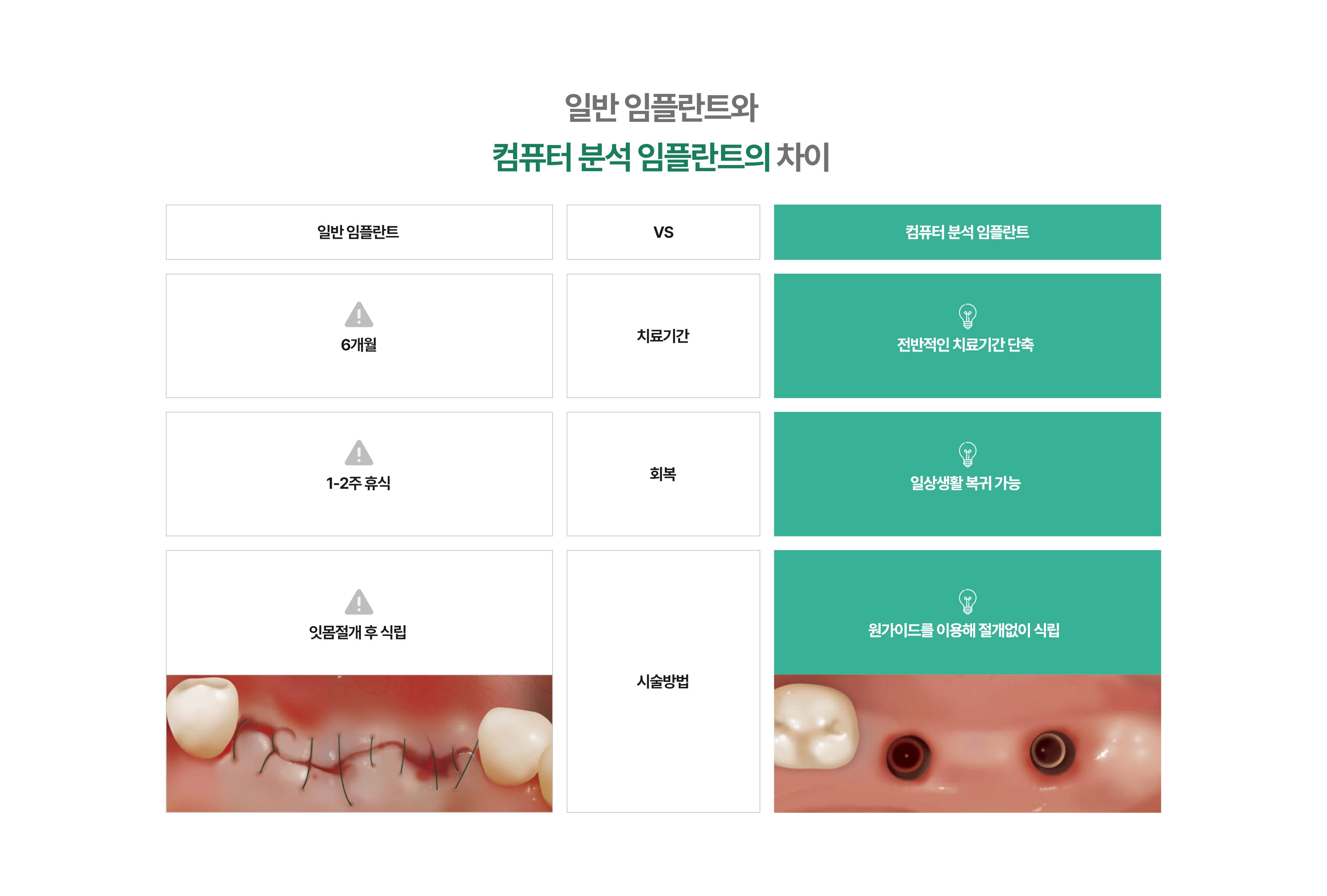 일반 임플란트와 네비게이션 임플란트의 차이